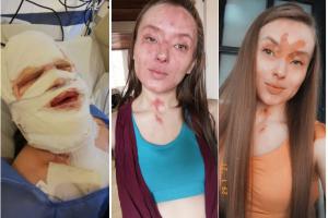 Joven atacada con ácido en Bogotá 