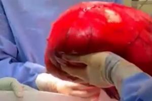 Mujer pensó estar 'gordita' y tenía un tumor de más de 8 kilos