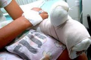 Sujeto perdió tres dedos lanzando un volador en Atlántico