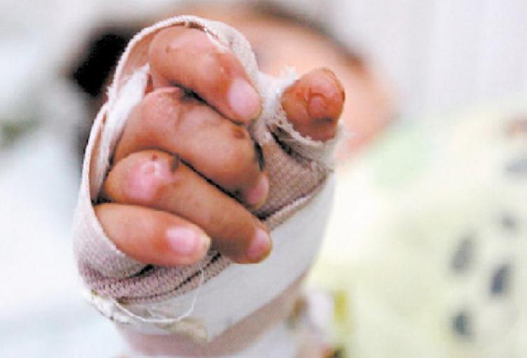 Quemado con pólvora