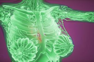 Tecnología detectaría cáncer de seno