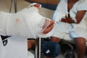 Quemado con Pólvora