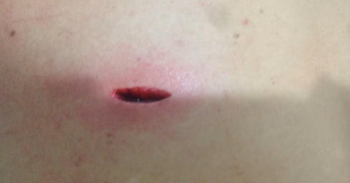 La apuñalaron tres veces durante la rumba, salió al hospital y murió en su casa en Bello