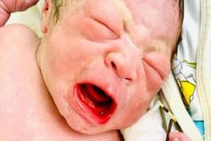 Bebé nació con el dispositivo anticonceptivo de la mamá en la mano
