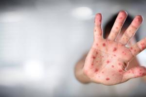 Madrid confirma 30 casos de viruela del mono y 6 regiones más con sospechosos