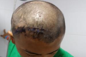 A punto de morir un joven de 18 años tras recibir machetazo en la cabeza en zona céntrica de Ibagué