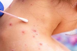 Utilizar preservativo durante las relaciones sexuales es una de las recomendaciones de la Alcaldía de Medellín