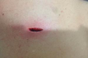 La apuñalaron tres veces durante la rumba, salió al hospital y murió en su casa en Bello