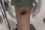Menor lesionada en Bello