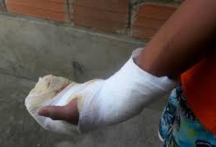 Quemados con pólvora en Norte de Santander