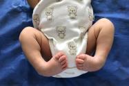 El tratamiento en los bebés.