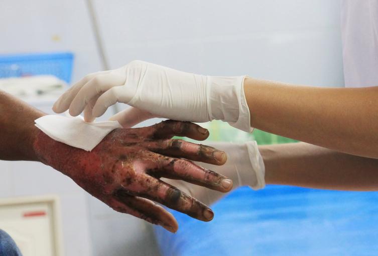 Quemados con pólvora en el Tolima