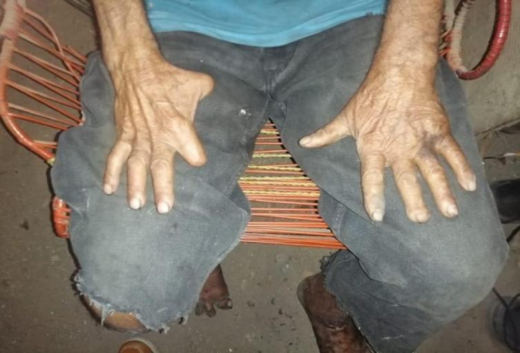 Lepra en Neiva