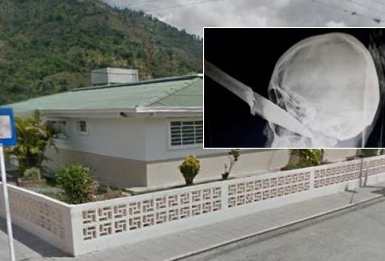 ¡Escalofriante! Un hombre llegó con un cuchillo incrustado en el ojo al hospital de Cajamarca