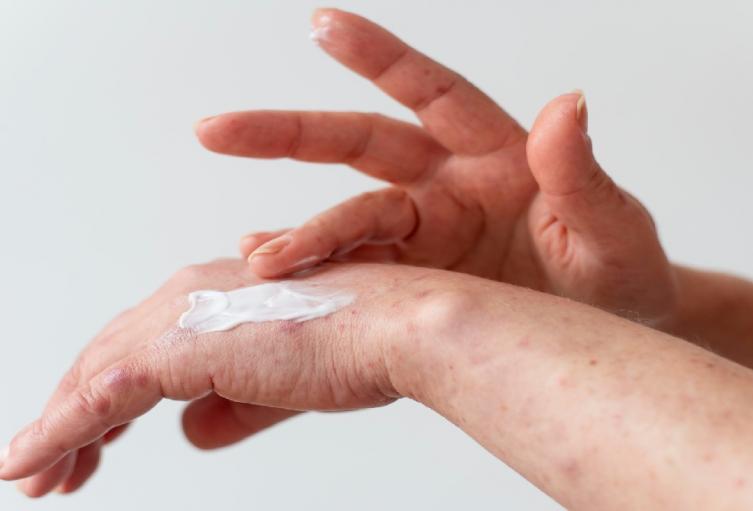 Dermatitis Dermatitis