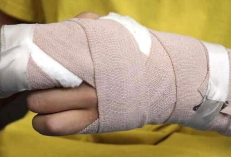 Quemados con pólvora Ibagué 