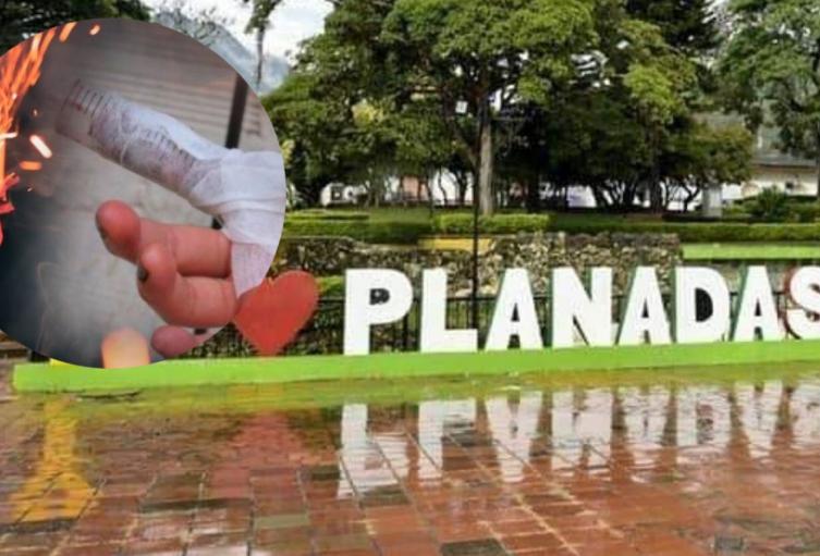 Planadas reporta su primer niño quemado; Tolima llega a 15 casos