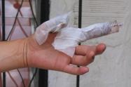 Mujer quemada con pólvora