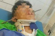Herido Arpón 