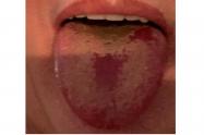 Lengua Covid