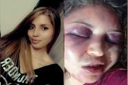 ¡Repudio! Mujer recibió brutal agresión por parte de su expareja en San Luis – Tolima