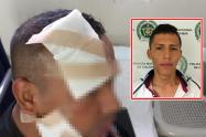 Le echó ácido en el rostro a un policía en medio de una riña en Ibagué