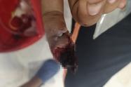 quemado con pólvora en Ibagué