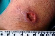 Leishmaniasis