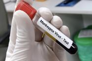 Anáisis de sangre por Viruela Símica 