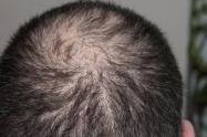 Pérdida de cabello
