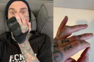 Travis Barker y su lesión en la mano