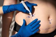 Abdominoplastia
