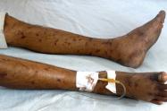 Meningitis