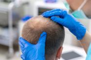 Implantes capilares