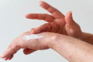 Dermatitis
