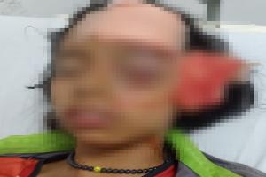 A punta de perder un ojo está niña de 10 años tras brutal ataque de un perro 