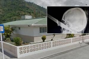 ¡Escalofriante! Un hombre llegó con un cuchillo incrustado en el ojo al hospital de Cajamarca