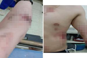 Quemado con pólvora en Palocabildo