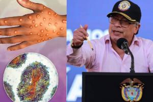 Gustavo Petro viruela del mono