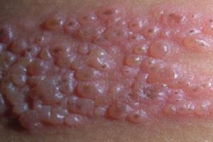 herpes zoster